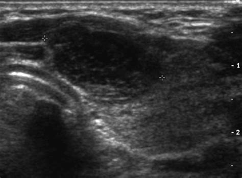 The increase in resistivity in a malignant lymph node is attributed to increased. . Ultrasound for lymphoma reddit
